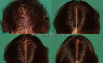 Hair restoration procedure before and after results