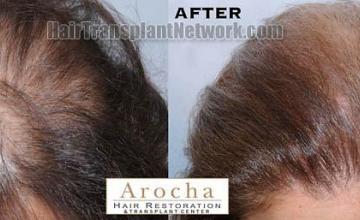 Hair restoration procedure results