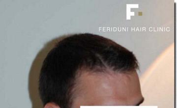 Hair restoration procedure results