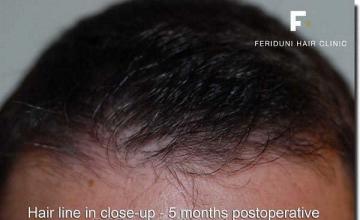 Hair restoration procedure results