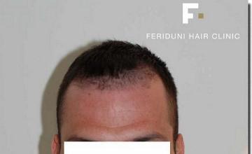 Hair restoration procedure results