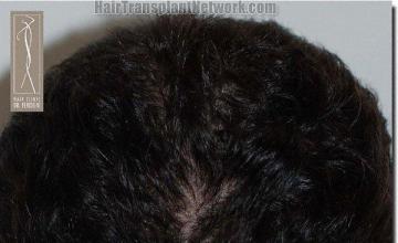 Hair restoration procedure results