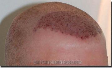 Hair restoration procedure results