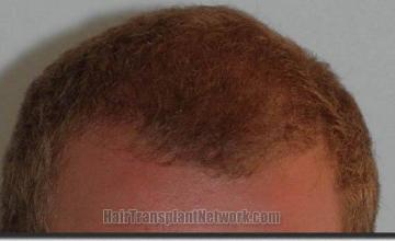 Hair restoration procedure results