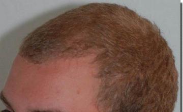 Hair restoration procedure results