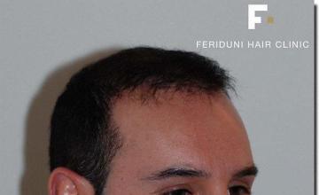 Hair restoration procedure results