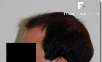 Hair restoration procedure results