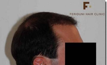 Hair restoration procedure results