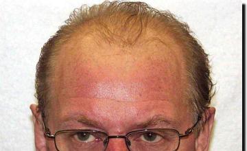 Hair restoration procedure results