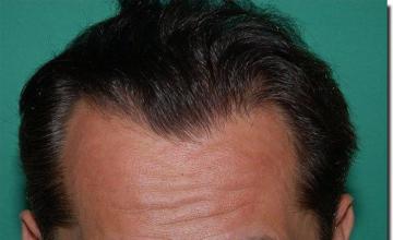 Hair restoration procedure results