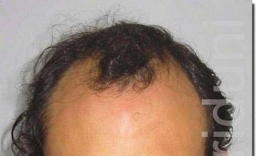 Hair restoration procedure results