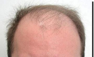 Hair restoration procedure results