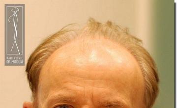 Hair restoration procedure results