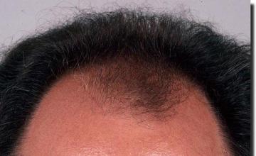 Hair restoration procedure results