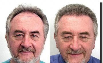 Hair restoration procedure results