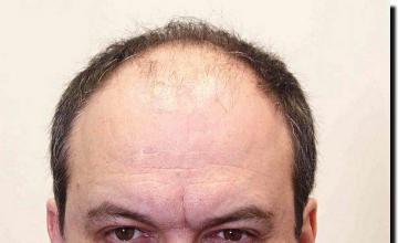 Hair restoration procedure results