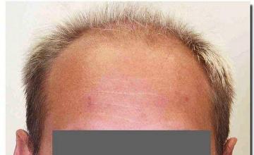 Hair restoration procedure results