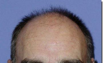 Hair restoration procedure results