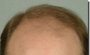 Hair restoration procedure results