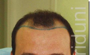 Hair restoration procedure results