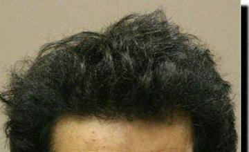 Hair restoration procedure results