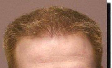 Hair restoration procedure results