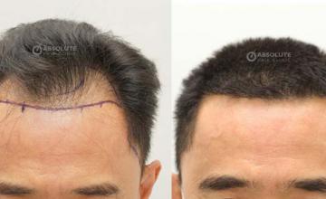 Frontal area before and after surgery 