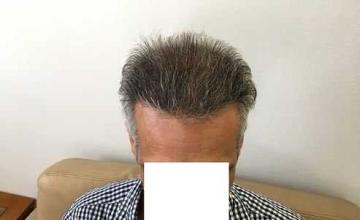 Frontal hairline after 2800 FUE grafts by Dr Christina