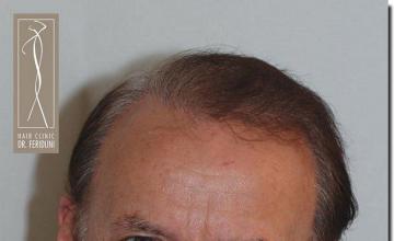 Hair restoration procedure results