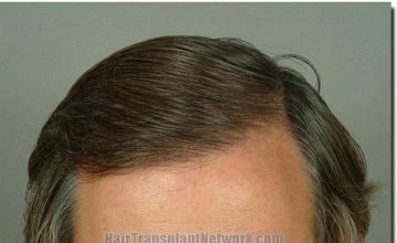 Hair restoration procedure results