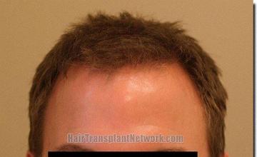 Hair restoration procedure results