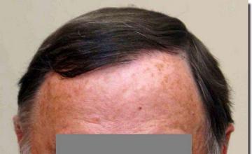 Hair restoration procedure results