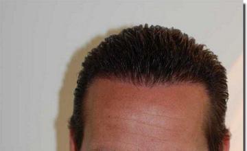 Hair restoration procedure results