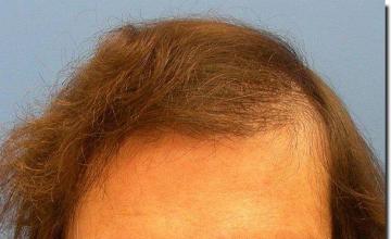 Hair restoration procedure results