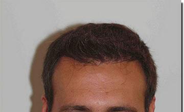 Hair restoration procedure results