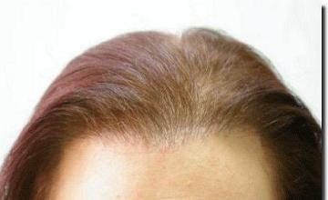 Hair restoration procedure results