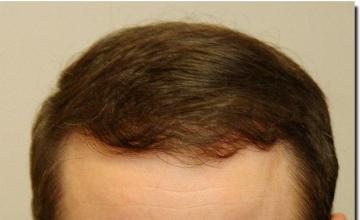 Hair restoration procedure results