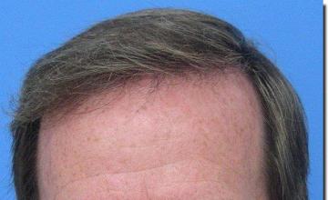 Hair restoration procedure results