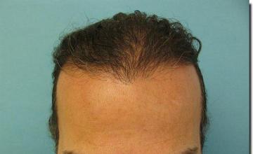 Hair restoration procedure results