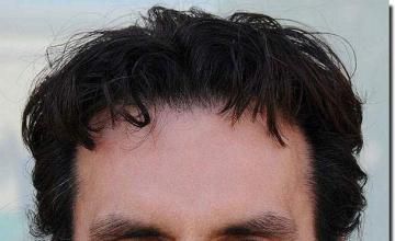 Hair restoration procedure results