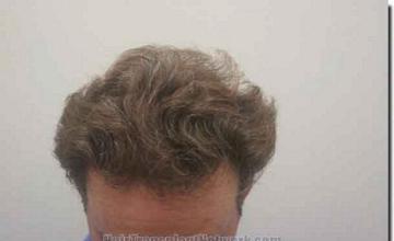 Hair restoration procedure results