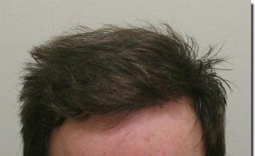 Hair restoration procedure results