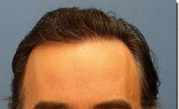 Hair restoration procedure results