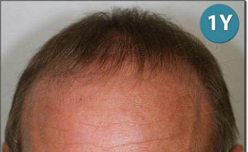 Hair restoration procedure results