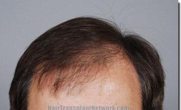 Hair restoration procedure results