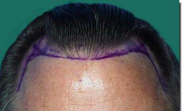 Hair restoration procedure results