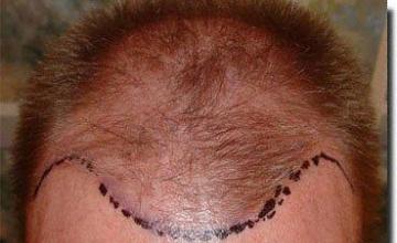 Hair restoration procedure results