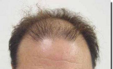 Hair restoration procedure results