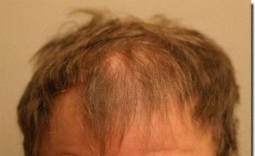 Hair restoration procedure results