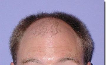 Hair restoration procedure results